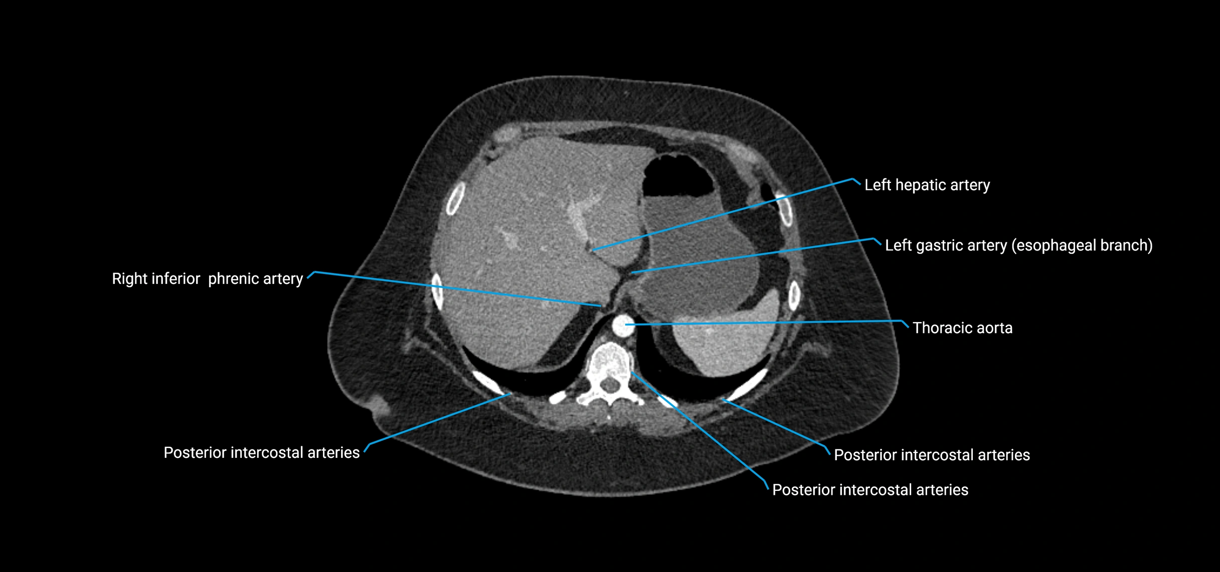 CTA abdomen axial cross sectional anatomy labelled image_32 (2).webp